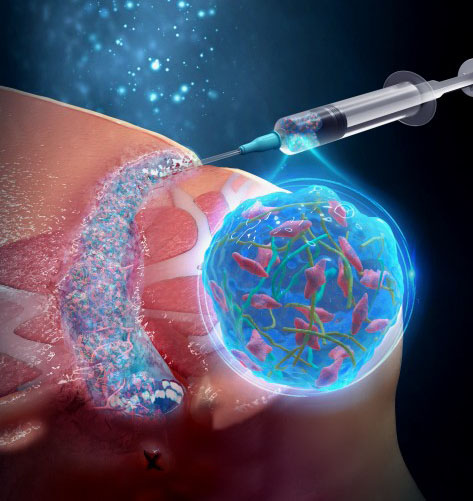 Verwendung des injizierbaren Nanofaser-Hydrogel-Verbundstoffs, der mit Stammzellen beladen ist, zur Behandlung von perianalen Fisteln