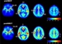 La oxigenoterapia hiperbárica aumenta el flujo sanguíneo cerebral