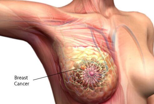 CBD And Breast Cancer Treatment - CBD vs THC - THC vs CBD