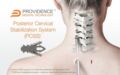 PCSS is an investigational implant system composed of non-segmental instrumentation with integrated screw fixation designed to provide immobilization and stabilization of spinal segments. PCSS is designed to achieve bilateral facet fixation at each level by spanning the interspace with points of fixation at each end of the construct.