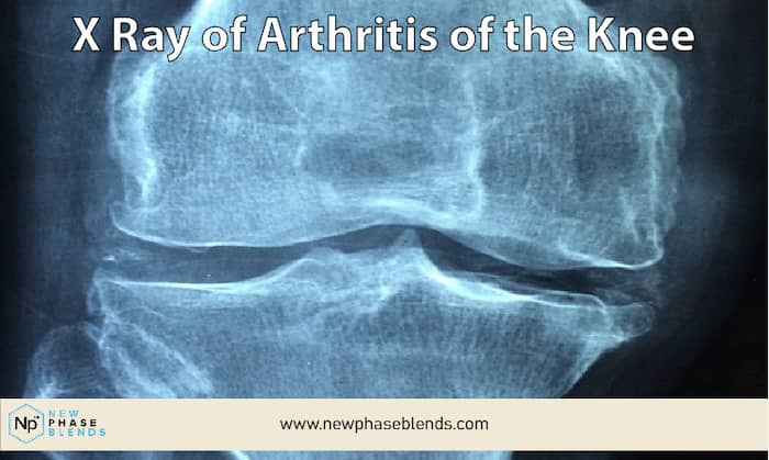 Raggi X di infiammazione articolare da artrite