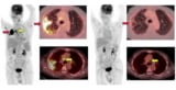 Imaging lung disease