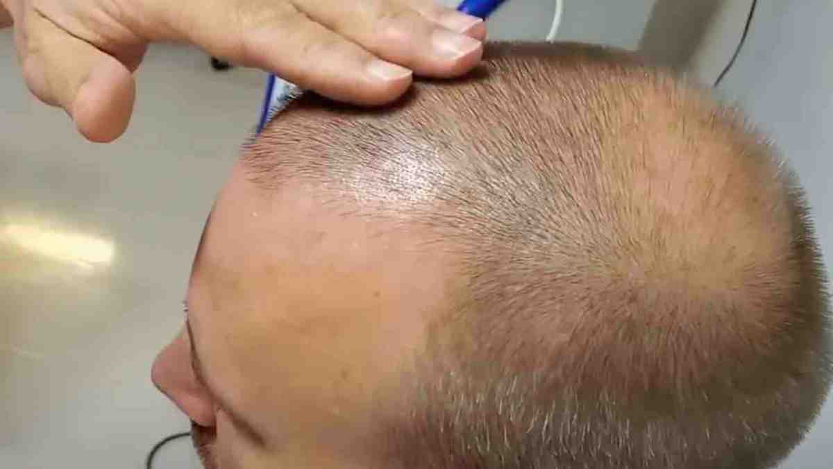 stem cell hair transplant, stem cell therapy for hair loss