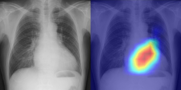 Diagnosticando doenças cardíacas a partir de uma radiografia de tórax