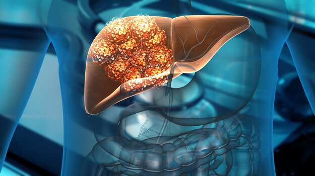 Resim: Karaciğerde/iStock'ta büyüyen kanser hücreleri, Rasi Bhadramani