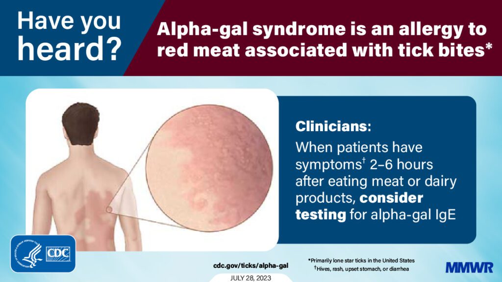 CDC Was ist das Alpha-Gal-Syndrom?