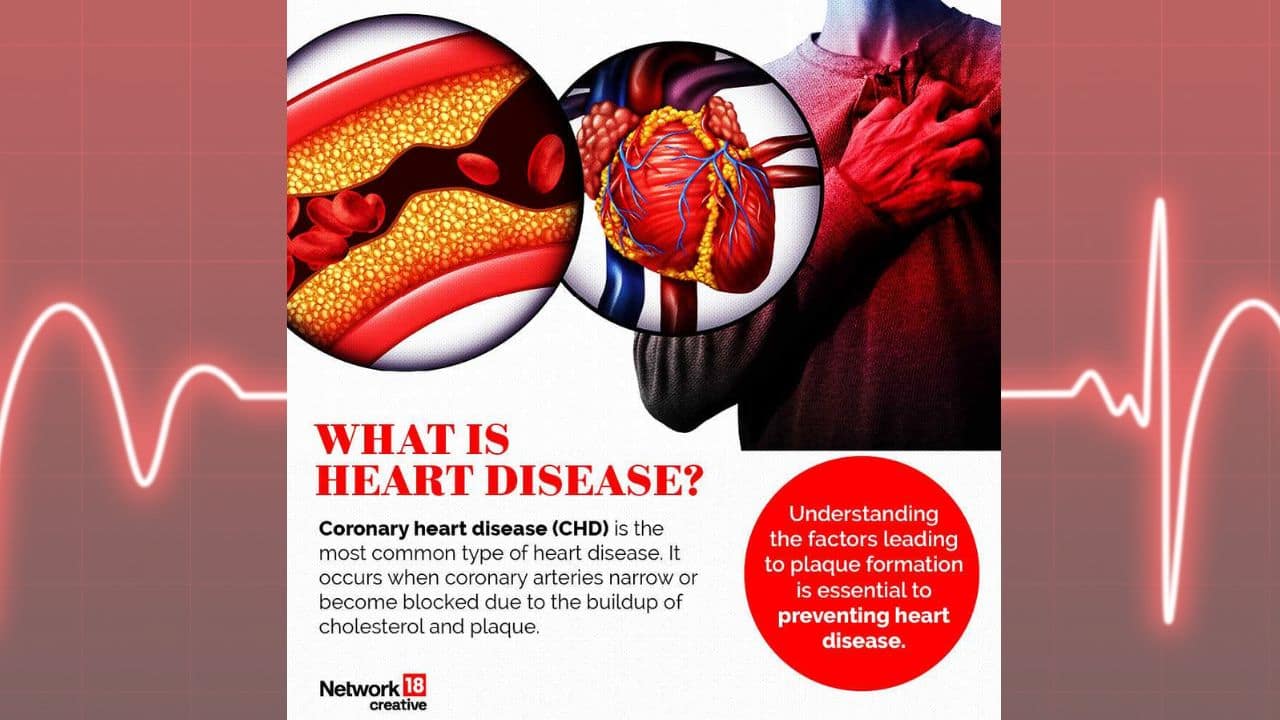 Coronary heart disease (CHD) is the most common type of heart disease. It occurs when coronary arteries narrow or become blocked due to the buildup of cholesterol and plaque. (Image: News18 creative)