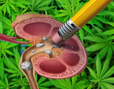 estudio de cálculos renales de cannabis