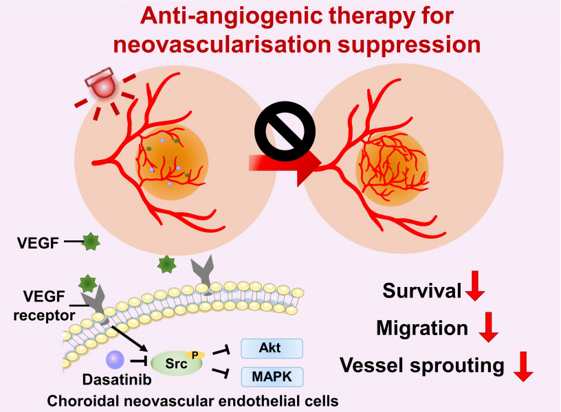 La terapia antiangiogénica suprime la neovascularización coroidea (CNV) al inhibir las vías relacionadas con el factor de crecimiento endotelial vascular (VEGF)