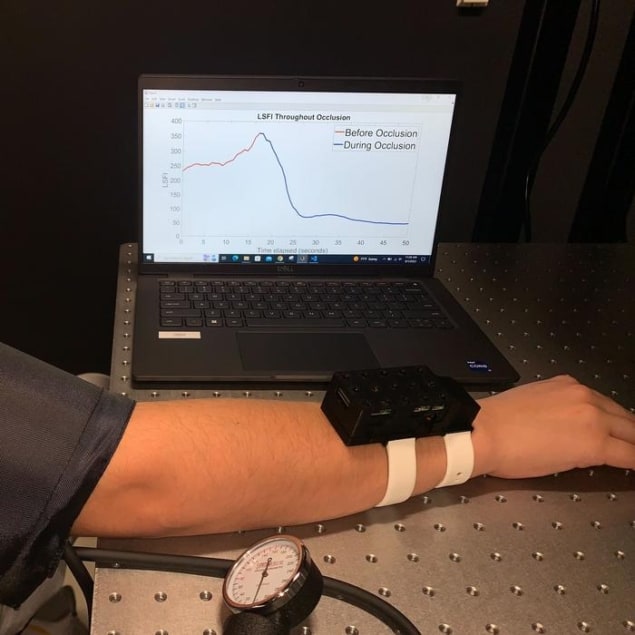 Foto de un nuevo dispositivo de imágenes portátil que monitorea los cambios en el flujo sanguíneo en las manos, los pies o los brazos de un paciente. El dispositivo está sujeto a la muñeca de una persona y la persona mira un gráfico en la pantalla de una computadora portátil.