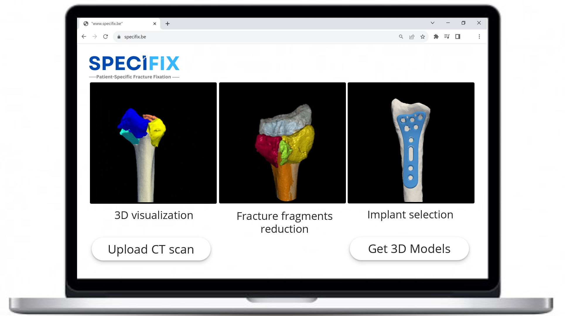 Specifix's software helps surgeons select the best personalised implants to stabilise wrist fractures.