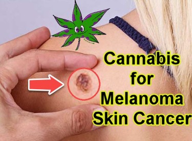 Marihuana gegen Melanom-Hautkrebs