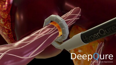 DeepQure initiates Early Feasibility Study for the HyperQure, the world's first extravascular RDN medical device for the treatment of resistant hypertension.